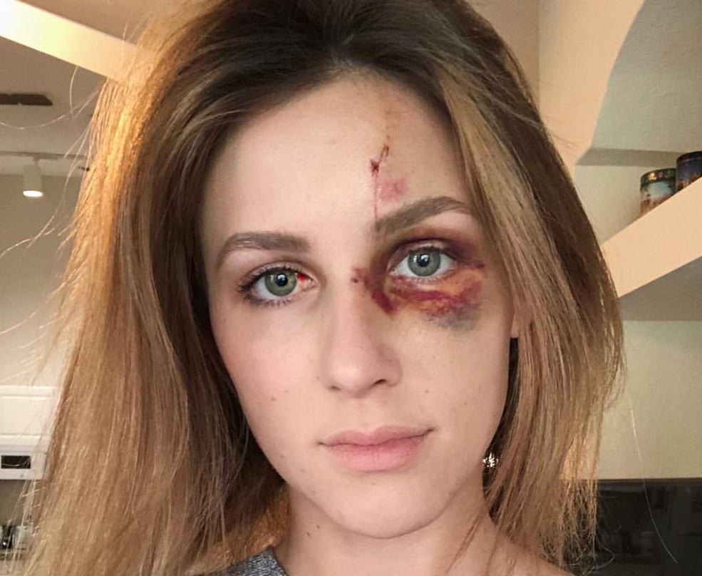 Instagram : elle diffuse les photos de son agression afin de lutter contre les violences conjugales