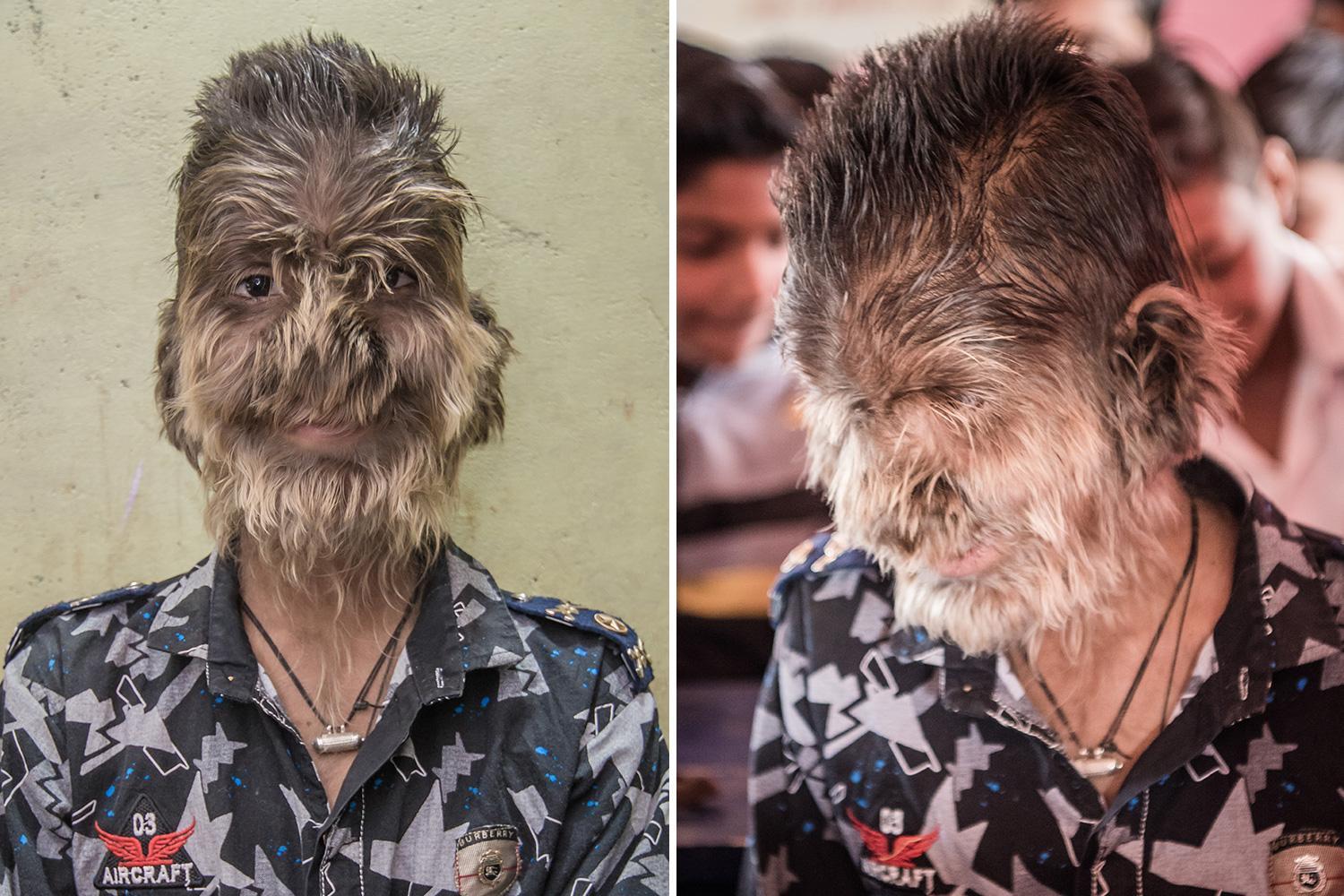 Mexique : l'homme loup-garou assume son visage recouvert de poils