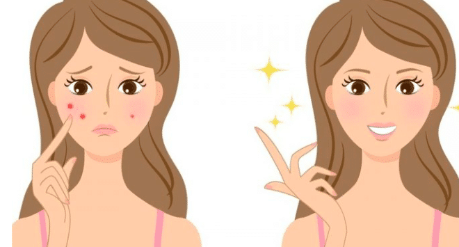 Les 4 traitements miracles pour faire disparaître les boutons d’acné rapidement