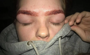 Brûlures à cause d'un kit à sourcils