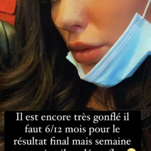 Jelena : opérée une nouvelle fois du nez, elle se montre sans ses pansements pour la 1ère fois