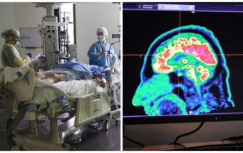 Covid-19 : comment le virus endommage le cerveau