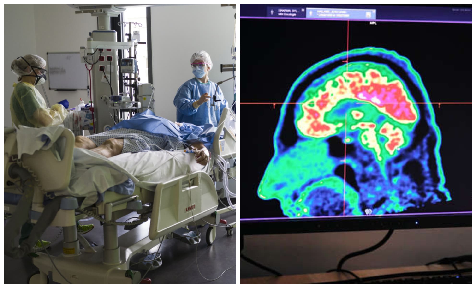 Covid-19 : comment le virus endommage le cerveau