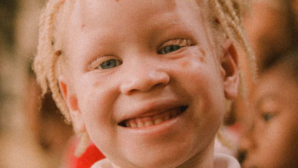 abdul-enfant-albinos