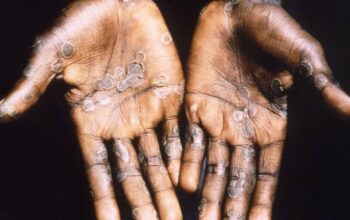 Symptômes, traitements, létalité, contagiosité... ce que l'on sait sur la variole du singe