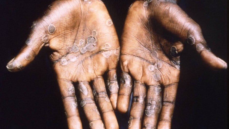 Symptômes, traitements, létalité, contagiosité... ce que l'on sait sur la variole du singe