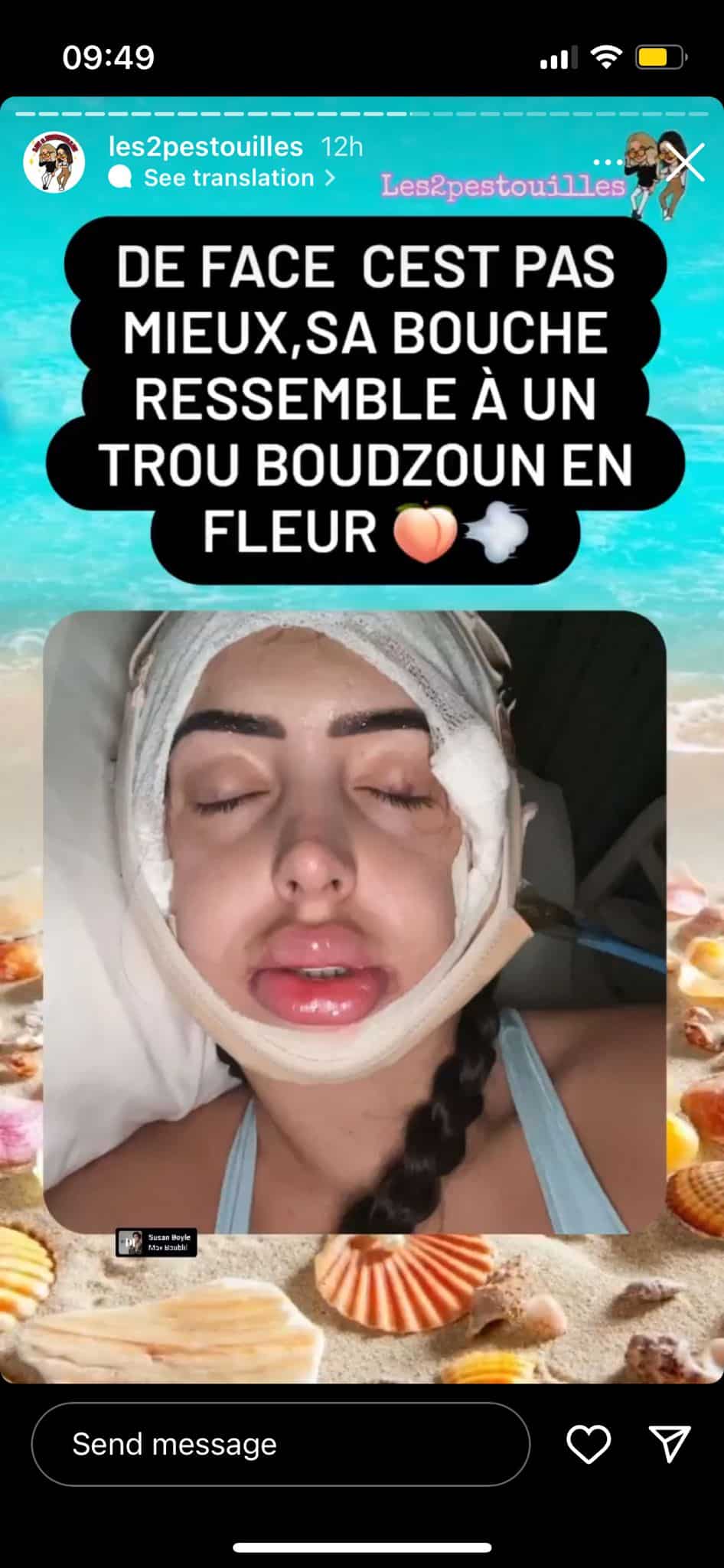 Léa Mary : le résultat de son opération de chirurgie interpelle