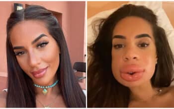 Marwa (Les Cinquante) : elle revient sur son allergie après des injections