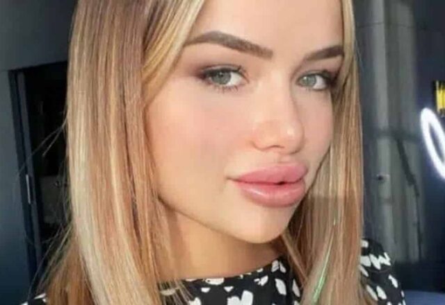 Victoria Mehault : elle retire l'acide hyaluronique de son visage, le résultat ne lui plaît pas