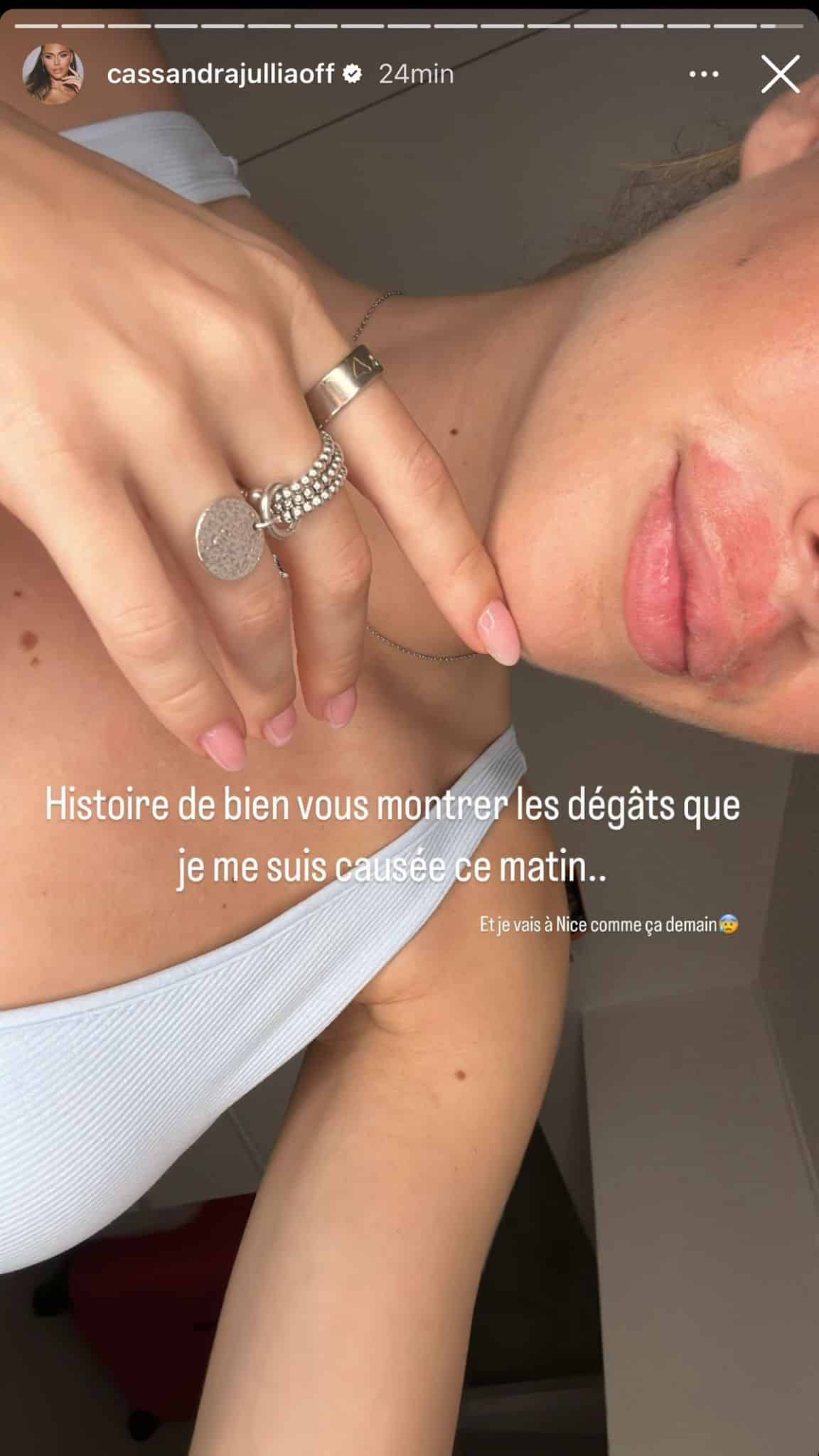 'Je suis bien brûlée' : Cassandra Jullia blessée au visage, elle est au plus mal