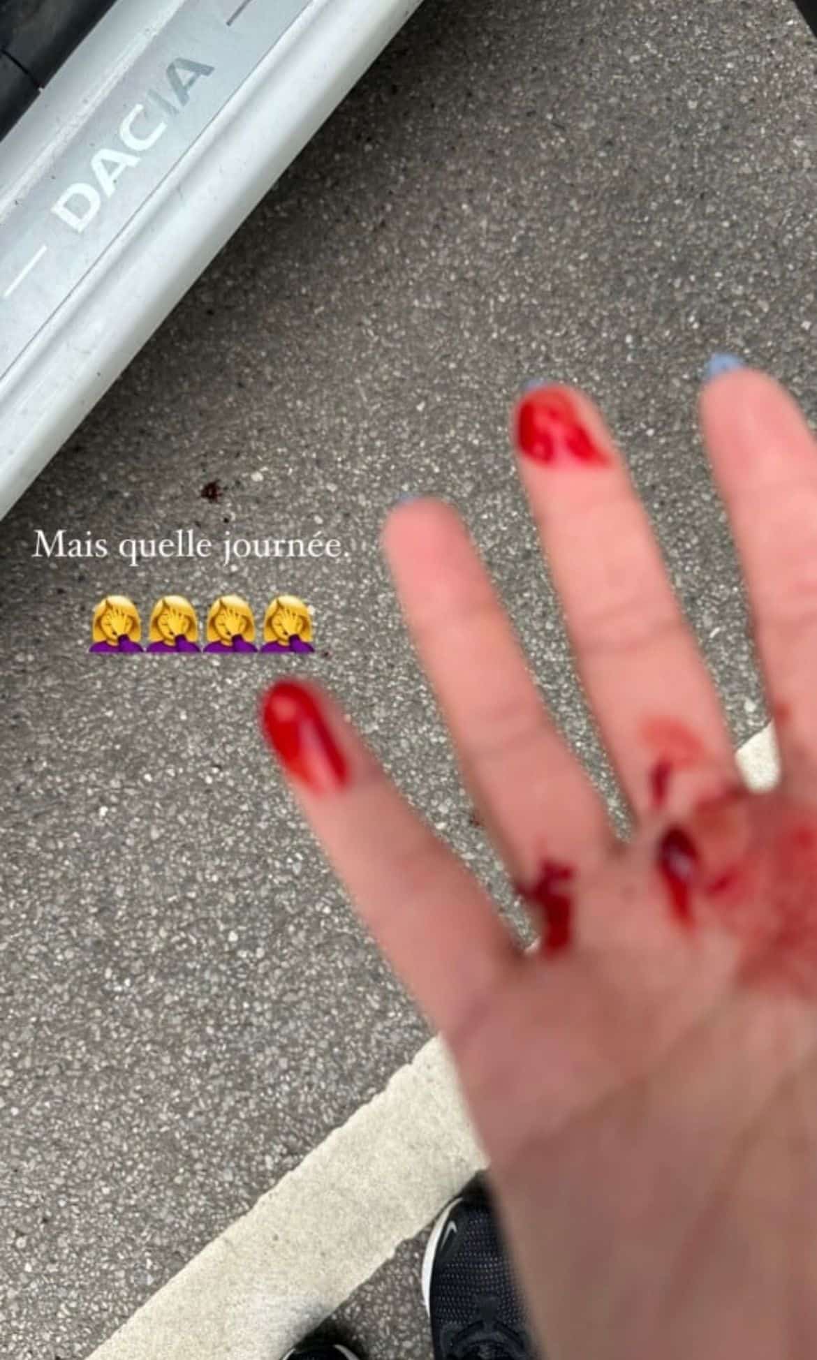 Stéphanie Clerbois : amochée après s'être pris sa portière dans le visage, elle montre sa blessure