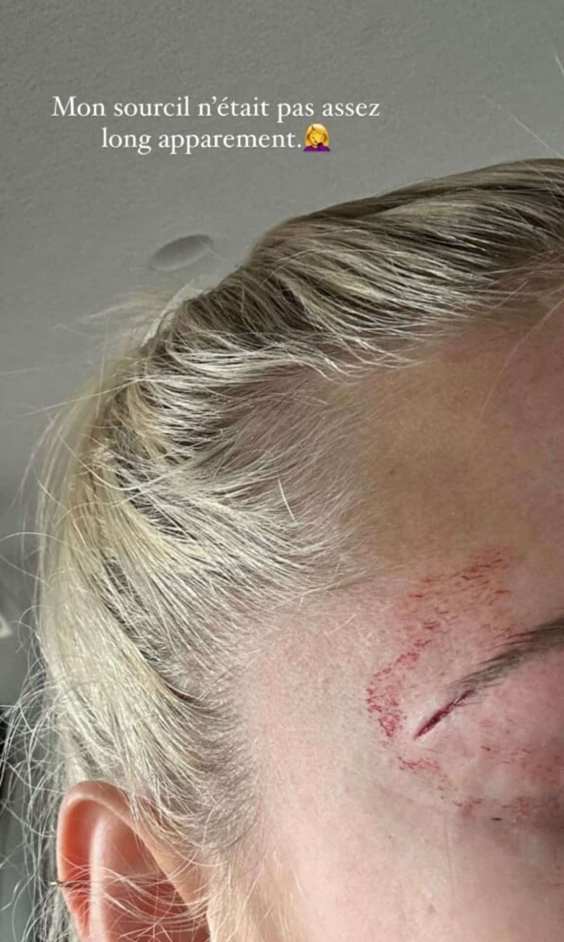 Stéphanie Clerbois : amochée après s'être pris sa portière dans le visage, elle montre sa blessure