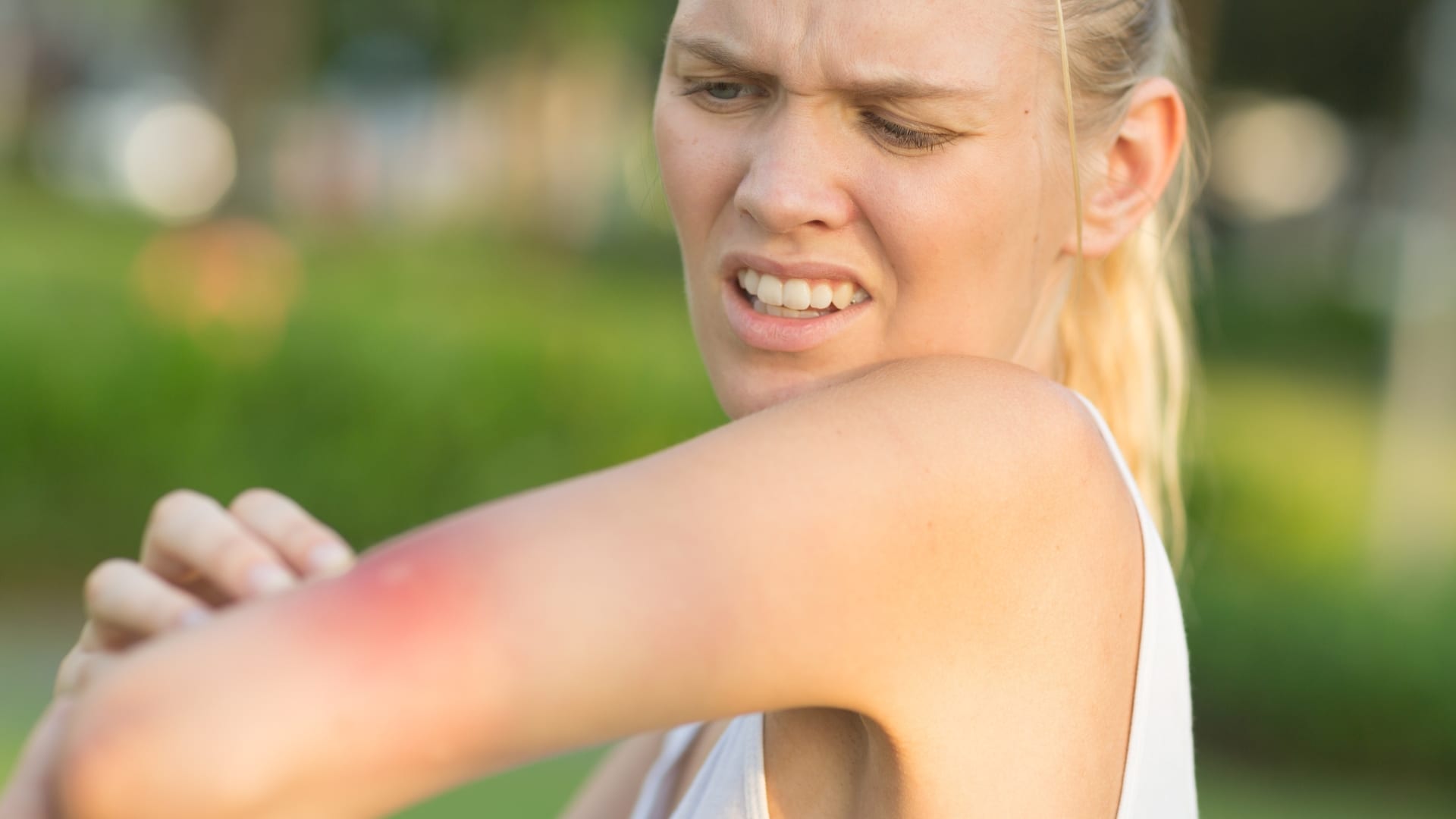 Piqûres de moustiques : une dermatologue donne son astuce efficace contre les démangeaisons