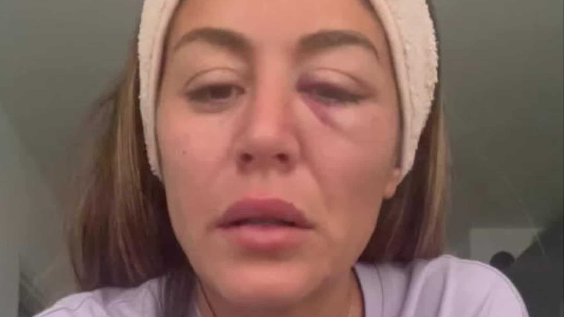 'Ne pas me laisser abattre' : Anaïs Camizuli (Les Cinquante) se livre sur son état de santé après son agression