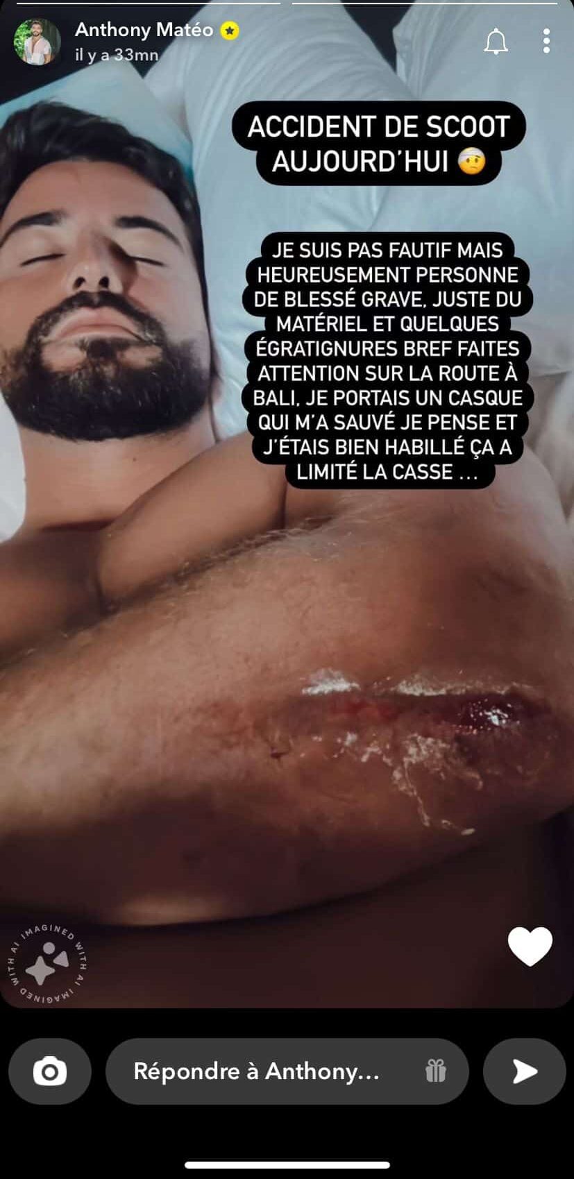 Anthony Matéo : après un accident de moto à Bali, il montre ses blessures