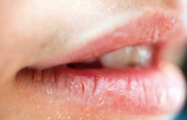 L’astuce des dermatologues pour se débarrasser définitivement des lèvres gercées