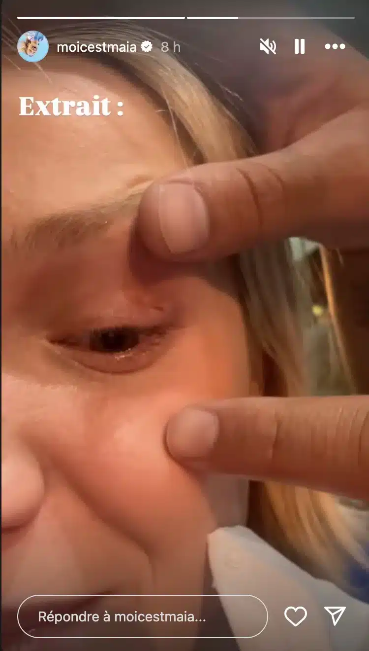 Maïa (Star Academy) : victime d'un accident, elle montre les images de son œil ouvert